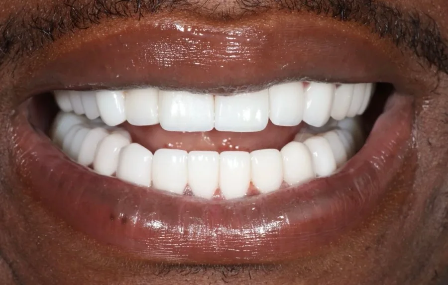 Smile shape refinement After