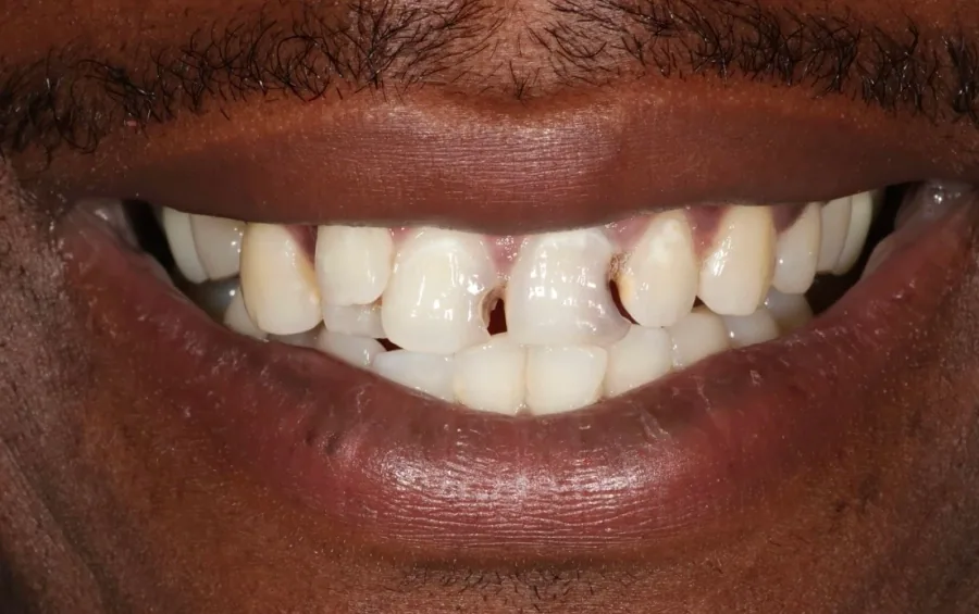 Smile shape refinement Before