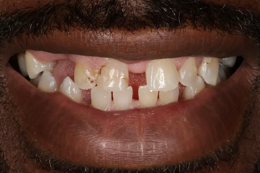 Complex restorative smile before
